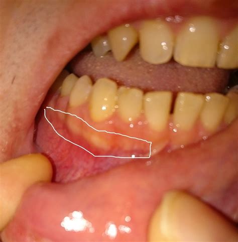 This growth might appear as a small lump or thickening of the skin. . White spot on gum above tooth reddit